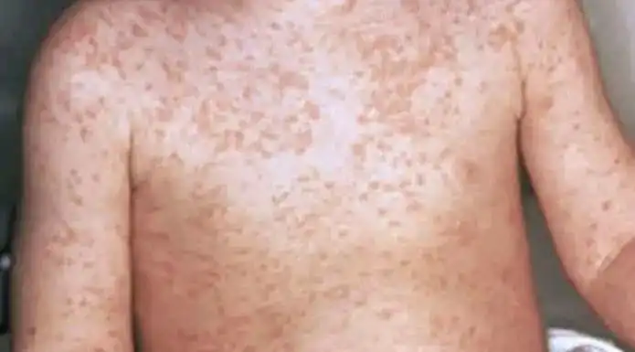 از ابتدای سال جاری، ۱.۵ هزار مورد ابتلا و ۱۰ مورد فوتی بر اثر سرخک در مأرب ثبت شده است.